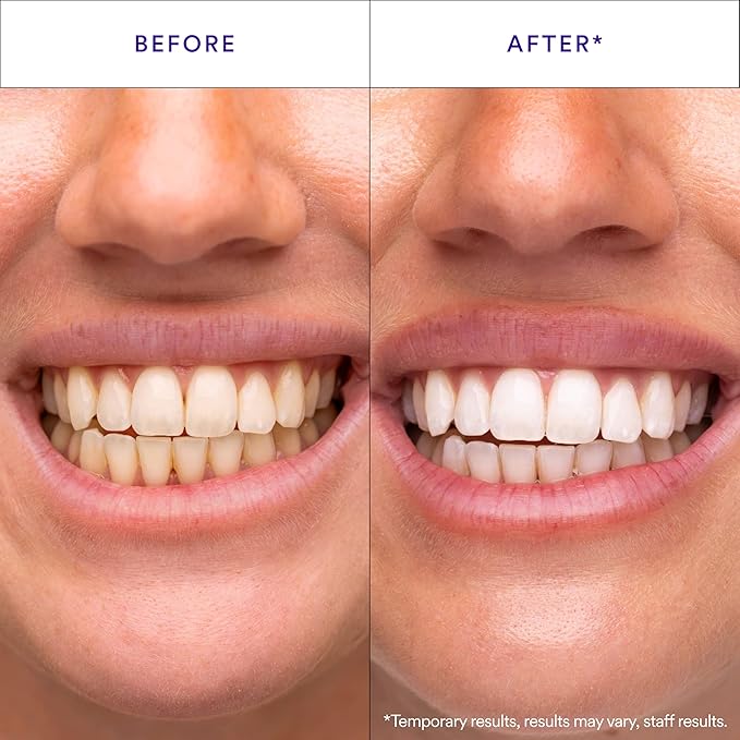Hismile V34 Whitening Strips, Teeth Whitening Strips