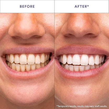 Hismile V34 Whitening Strips, Teeth Whitening Strips
